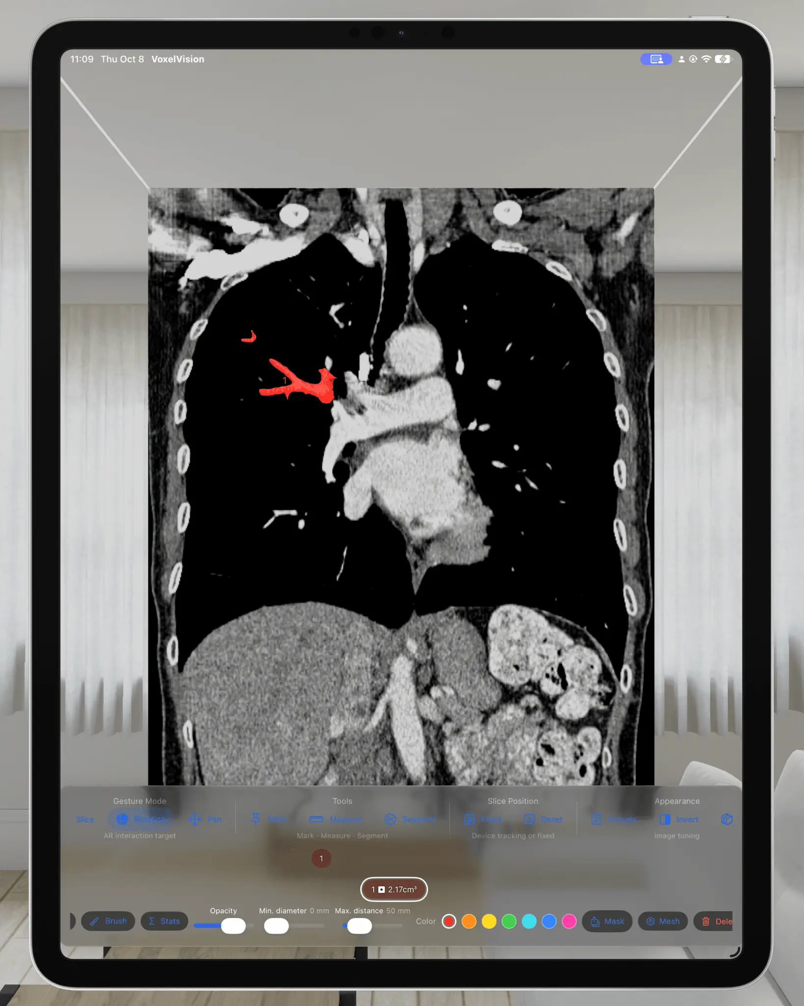 Screenshot 2 of VoxelVision AR Medical Imaging